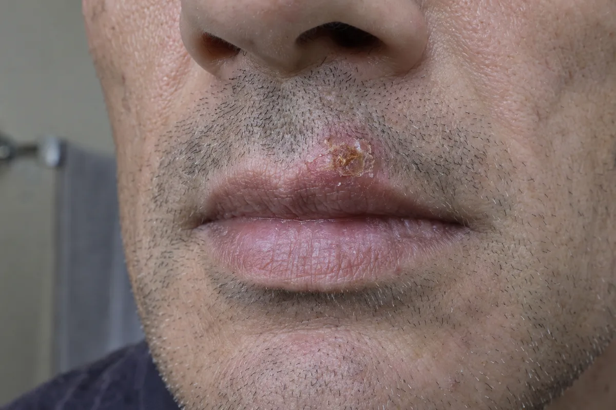 Cold sore at the crusting stage on the upper lip