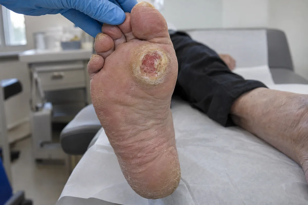 Diabetic foot ulcer under the ball of the foot, a round wound with a ring of thick callus around it