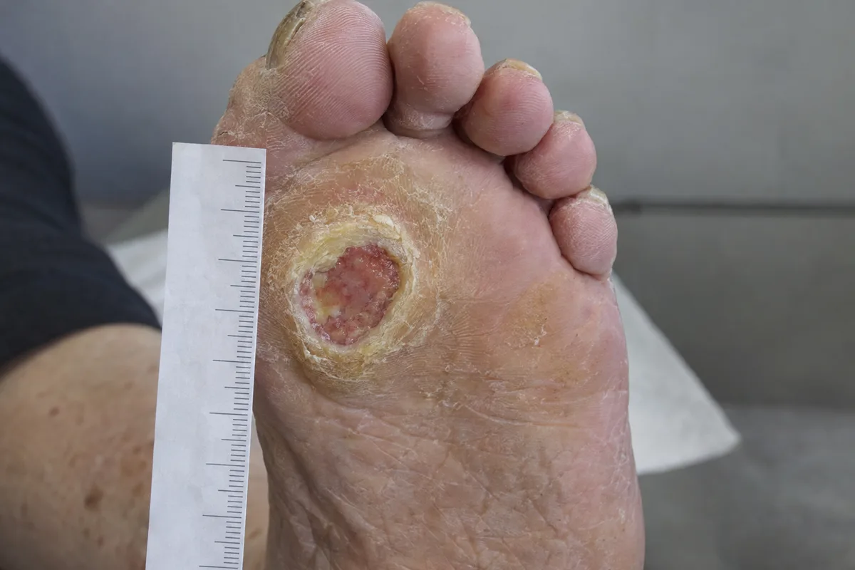 Close view of a diabetic foot ulcer under the ball of the foot, a round wound with a ring of thick callus around it, measured with a paper ruler