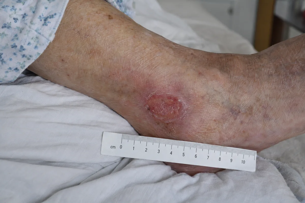 Stage 2 pressure sore on the outer ankle bone, measured with a paper ruler
