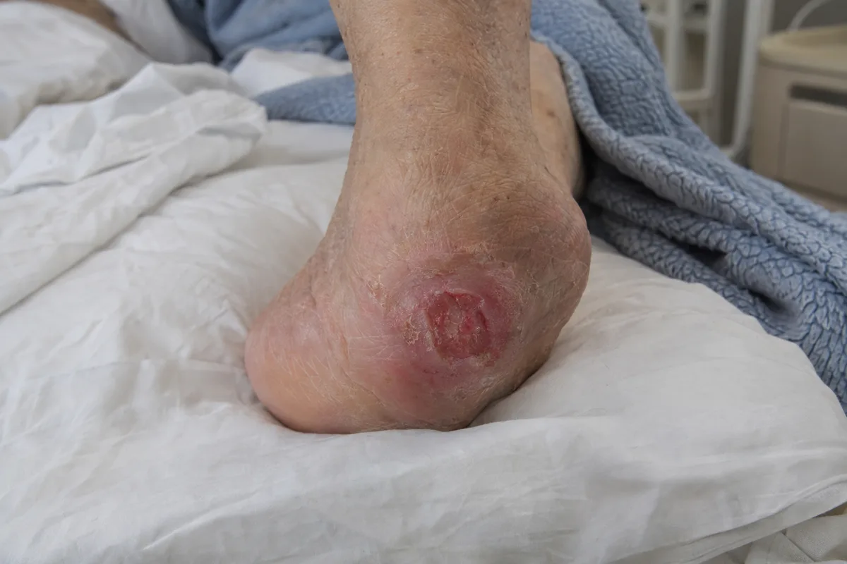 Stage 2 pressure sore on the back of the heel of an older man resting in bed