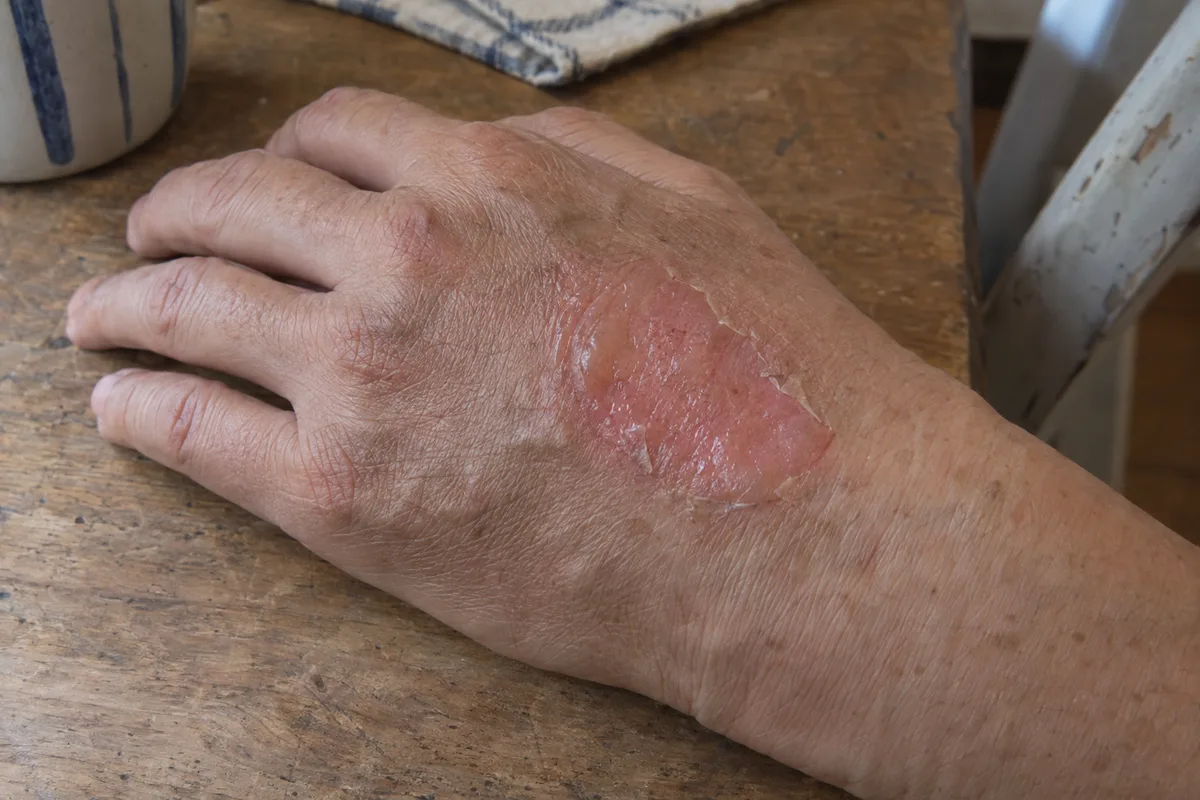 Minor second-degree burn on the back of the hand with a flat blister and peeling edge