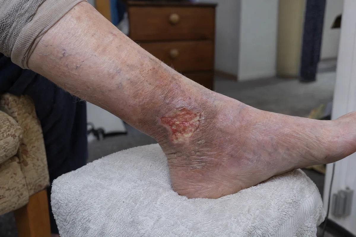 Venous leg ulcer just above the ankle, with brownish stained skin around it
